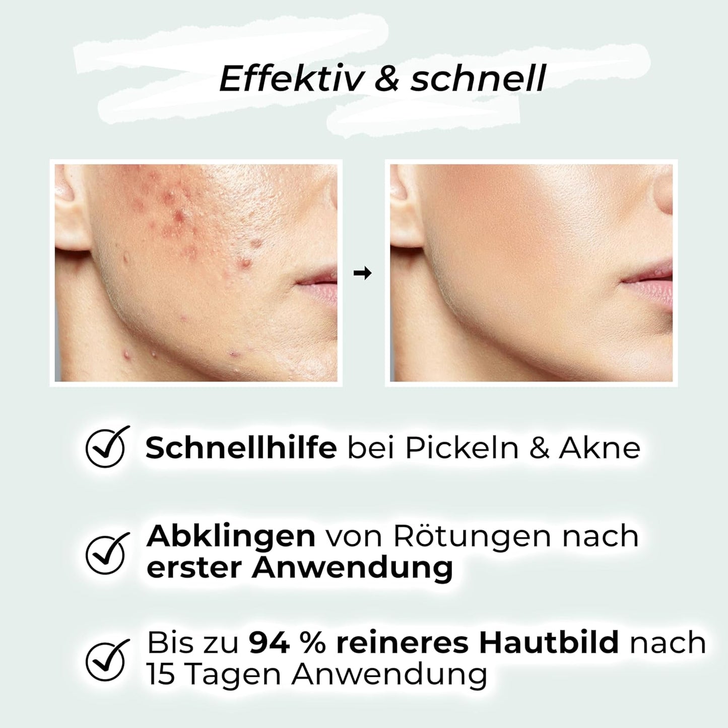VIGOROUS® Zinksalbe Gegen Pickel 60Ml - anti Pickel Creme Auch Für Pickel Am Po Und Rücken -Mit Teebaumöl & Salicylsäure - SOS Zink Salbe Gegen Mitesser Und Unreine Haut - Zugsalbe Pickel - Akne Creme