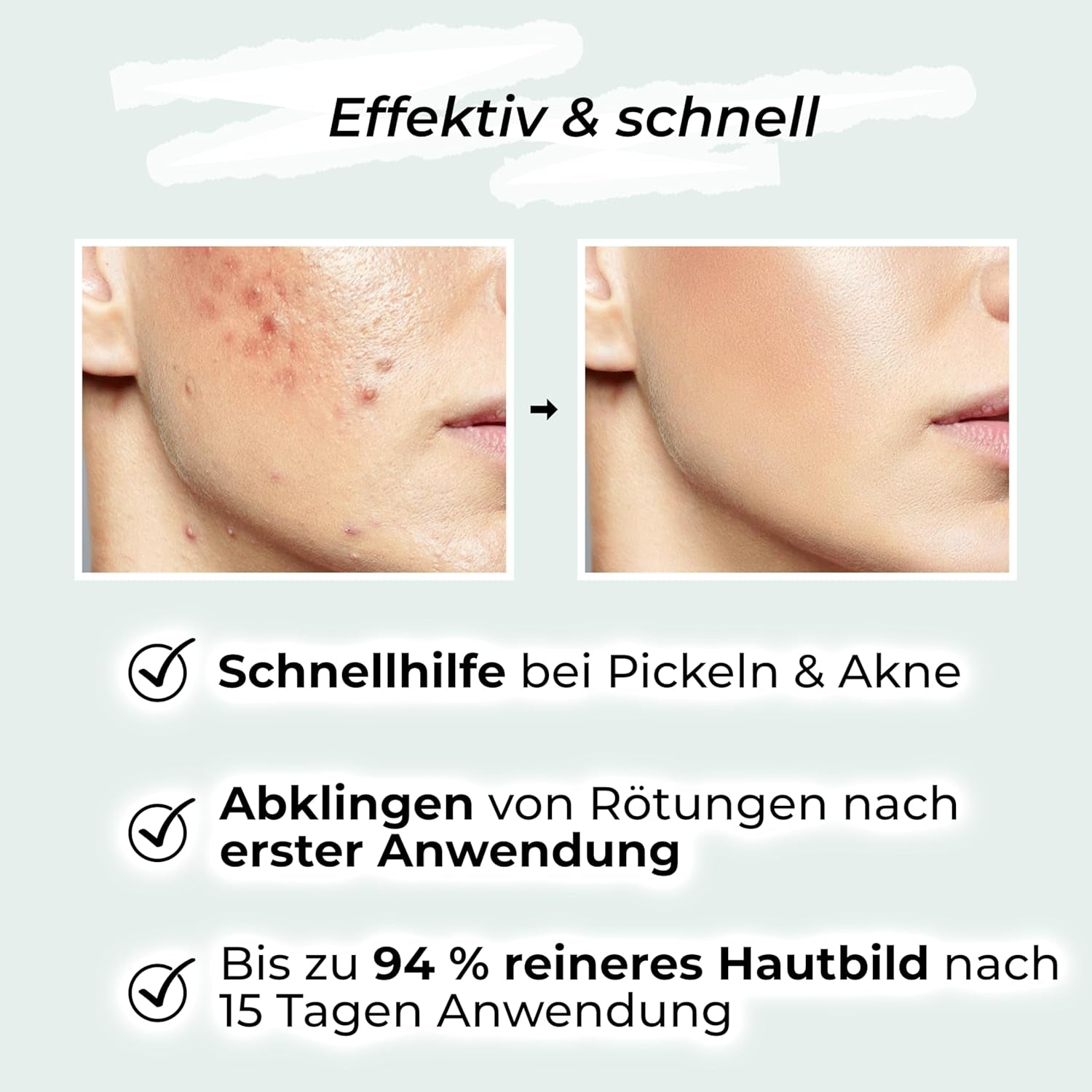 VIGOROUS® Zinksalbe Gegen Pickel 60Ml - anti Pickel Creme Auch Für Pickel Am Po Und Rücken -Mit Teebaumöl & Salicylsäure - SOS Zink Salbe Gegen Mitesser Und Unreine Haut - Zugsalbe Pickel - Akne Creme