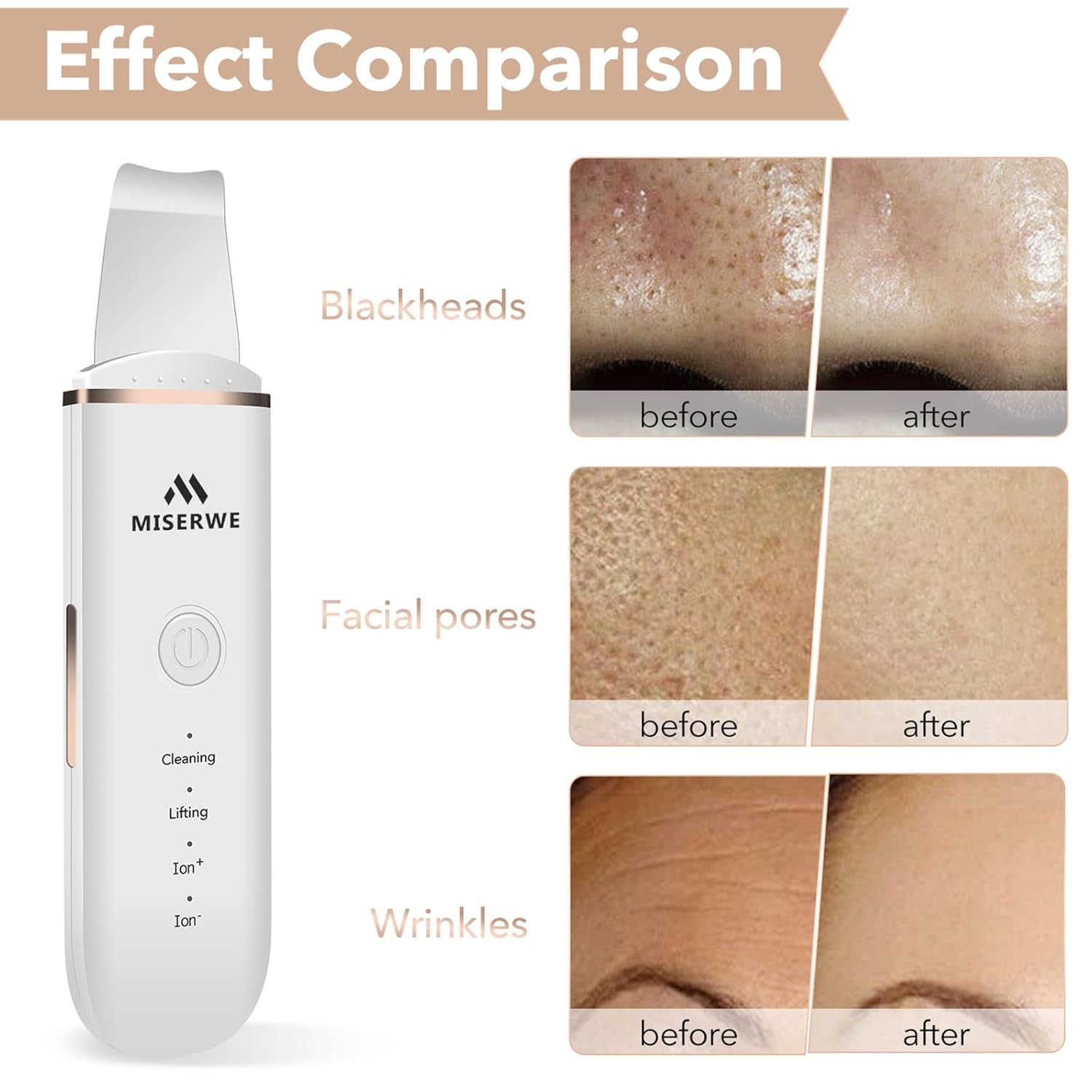 Skin Scrubber Face Skin Spatula Ultraschallpeelinggerät Skin Scrubber Mitesserentferner Porenreiniger Werkzeug Mitesser-Extraktor Für Tiefenreinigung